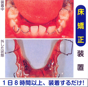 基本は床矯正です！