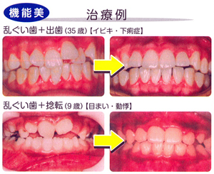 矯正治療例