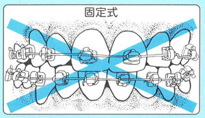 歯をしばりつけたりしません！